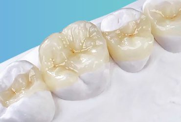 Ricostruzioni Dentarie Indirette