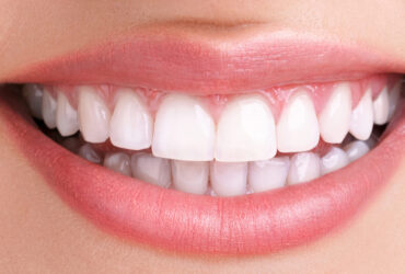 Sbiancamento Dentale