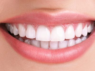 Sbiancamento dentale1