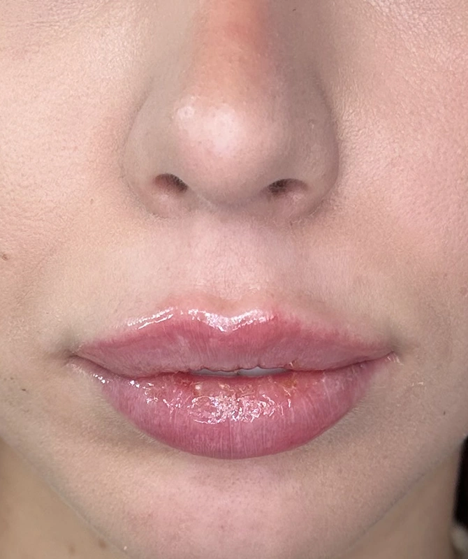 mortillaro-filler-labbra-dopo-1