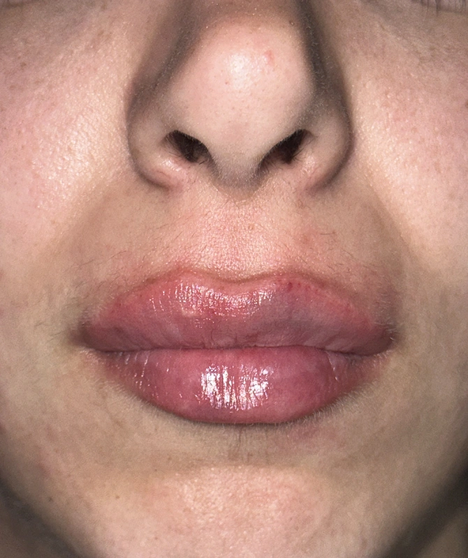 mortillaro-filler-labbra-dopo-2