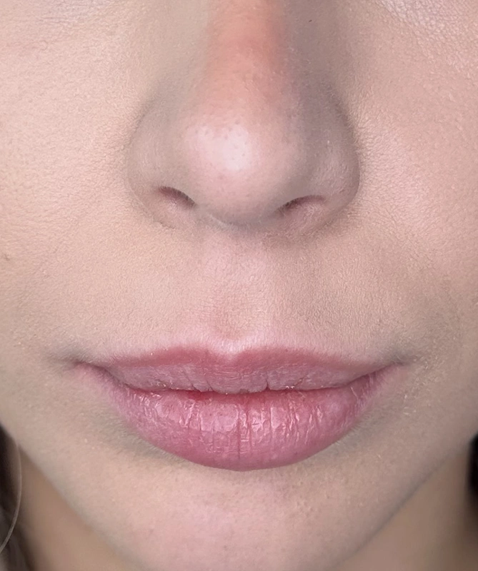 mortillaro-filler-labbra-prima-1