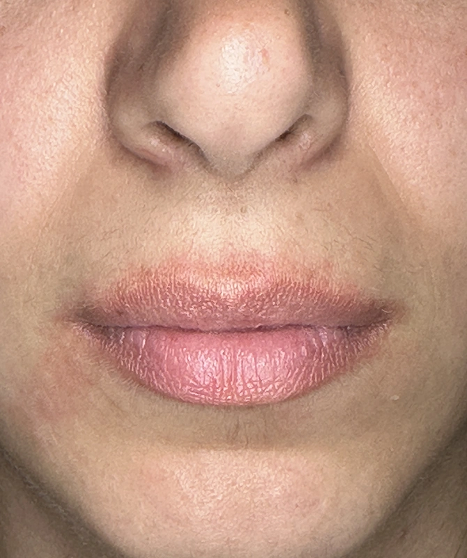 mortillaro-filler-labbra-prima-2